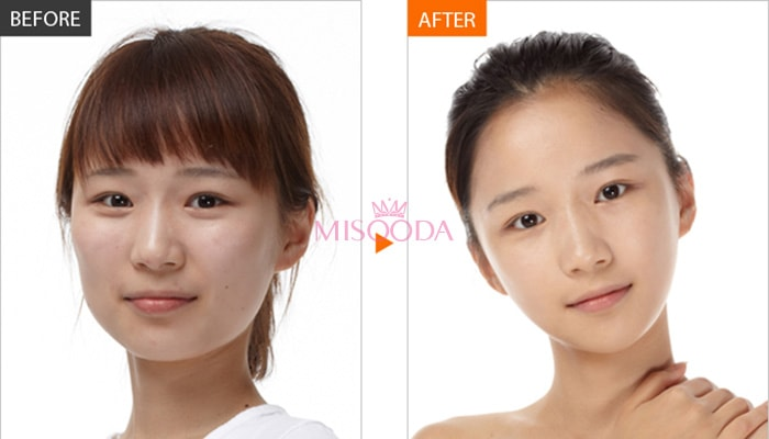 Korean skin treatment before and after — MISOODA patient glass skin result