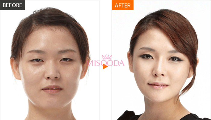Korea V-line contouring before and after — MISOODA verified patient