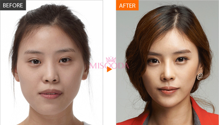 Korea rhinoplasty before and after — MISOODA verified patient