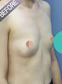 breast