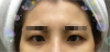 Hidden eyelids and Forehead fat grafting — Korea cost, reviews & before-after | MISOODA