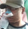 Rhinoplasty Revision — Korea cost, reviews & before-after | MISOODA