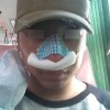 Rhinoplasty Revision — Korea cost, reviews & before-after | MISOODA