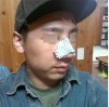Rhinoplasty Revision — Korea cost, reviews & before-after | MISOODA
