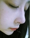 natural nose — Korea cost, reviews & before-after | MISOODA