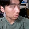 Rhinoplasty Revision — Korea cost, reviews & before-after | MISOODA