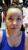 Jaw + Eyelid Revision, Accusculpt, Fat Graft — Korea cost, reviews & before-after | MISOODA