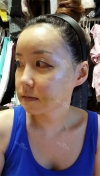 Jaw + Eyelid Revision, Accusculpt, Fat Graft — Korea cost, reviews & before-after | MISOODA