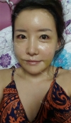 Jaw + Eyelid Revision, Accusculpt, Fat Graft — Korea cost, reviews & before-after | MISOODA
