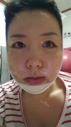Jaw + Eyelid Revision, Accusculpt, Fat Graft — Korea cost, reviews & before-after | MISOODA