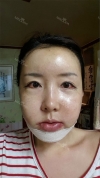 Jaw + Eyelid Revision, Accusculpt, Fat Graft — Korea cost, reviews & before-after | MISOODA