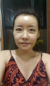 Jaw + Eyelid Revision, Accusculpt, Fat Graft — Korea cost, reviews & before-after | MISOODA