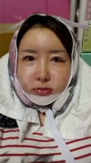Jaw + Eyelid Revision, Accusculpt, Fat Graft — Korea cost, reviews & before-after | MISOODA