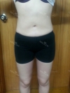 30 years old get your self confidence with a sexy body! — Korea cost, reviews & before-after | MISOODA