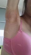32 years old, Flat breast was transformed! — Korea cost, reviews & before-after | MISOODA
