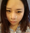Rhinoplasty — Korea cost, reviews & before-after | MISOODA