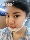 Square jaw reduction + Double eyelid revision surgery — Korea cost, reviews & before-after | MISOODA