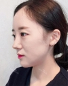 chin-+-rhinoplasty — Korea cost, reviews & before-after | MISOODA