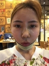 Jaw Reduction, Rhinoplasty and Breast Augmentation in Korea — Korea cost, reviews & before-after | MISOODA