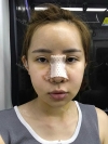 Jaw Reduction, Rhinoplasty and Breast Augmentation in Korea — Korea cost, reviews & before-after | MISOODA