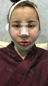 Jaw Reduction, Rhinoplasty and Breast Augmentation in Korea — Korea cost, reviews & before-after | MISOODA
