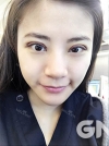 Square jaw reduction + Double eyelid revision surgery — Korea cost, reviews & before-after | MISOODA
