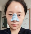 chin-+-rhinoplasty — Korea cost, reviews & before-after | MISOODA