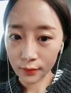 chin-+-rhinoplasty — Korea cost, reviews & before-after | MISOODA