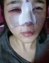 Forehead fat grafting + Rhinoplasty — Korea cost, reviews & before-after | MISOODA