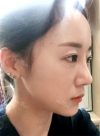 chin-+-rhinoplasty — Korea cost, reviews & before-after | MISOODA