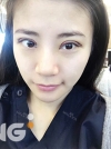 Square jaw reduction + Double eyelid revision surgery — Korea cost, reviews & before-after | MISOODA