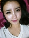 Forehead fat grafting + Rhinoplasty — Korea cost, reviews & before-after | MISOODA