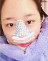 chin-+-rhinoplasty — Korea cost, reviews & before-after | MISOODA