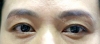 Eyebrow lift — Korea cost, reviews & before-after | MISOODA