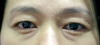 Eyebrow lift — Korea cost, reviews & before-after | MISOODA