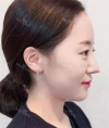 chin-+-rhinoplasty — Korea cost, reviews & before-after | MISOODA