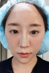 chin-+-rhinoplasty — Korea cost, reviews & before-after | MISOODA