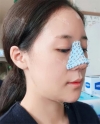 chin-+-rhinoplasty — Korea cost, reviews & before-after | MISOODA