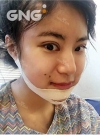 Square jaw reduction + Double eyelid revision surgery — Korea cost, reviews & before-after | MISOODA