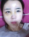 Forehead fat grafting + Rhinoplasty — Korea cost, reviews & before-after | MISOODA