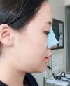 chin-+-rhinoplasty — Korea cost, reviews & before-after | MISOODA