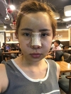 Jaw Reduction, Rhinoplasty and Breast Augmentation in Korea — Korea cost, reviews & before-after | MISOODA
