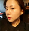 Rhinoplasty — Korea cost, reviews & before-after | MISOODA