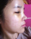 Forehead fat grafting + Rhinoplasty — Korea cost, reviews & before-after | MISOODA