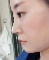 chin-+-rhinoplasty — Korea cost, reviews & before-after | MISOODA