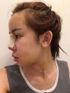 Jaw Reduction, Rhinoplasty and Breast Augmentation in Korea — Korea cost, reviews & before-after | MISOODA