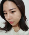 Rhinoplasty — Korea cost, reviews & before-after | MISOODA