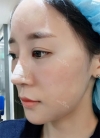 chin-+-rhinoplasty — Korea cost, reviews & before-after | MISOODA