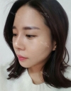 Rhinoplasty — Korea cost, reviews & before-after | MISOODA
