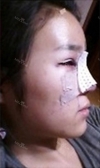 Forehead fat grafting + Rhinoplasty — Korea cost, reviews & before-after | MISOODA